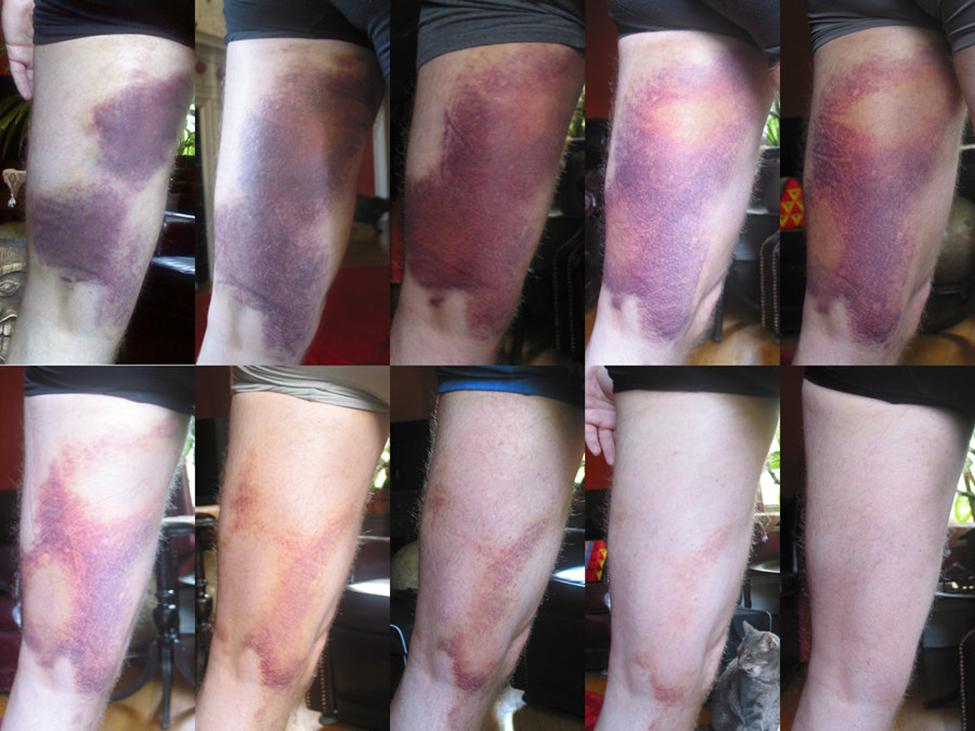 Bruise Color Chart