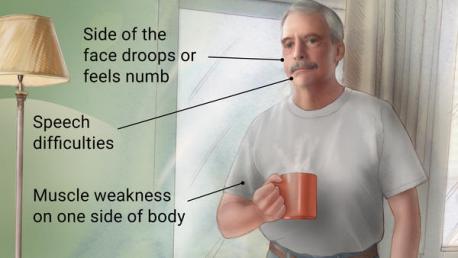 Stroke is the 5th leading cause of death in the US (after heart disease, cancer, chronic lower respiratory disease and accidents). Has your life been touched by stroke--either occurring to yourself or a loved one?