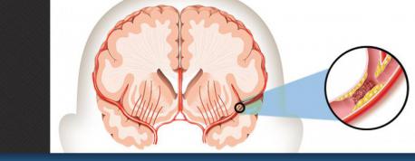 A stroke occurs when blood supply is cut off to an area of the brain. Brain cells are then deprived of oxygen and die. Have you, personally, ever been diagnosed with any type of stroke?