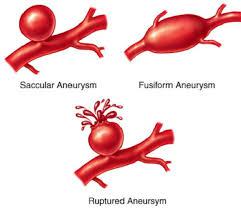 The two types of stroke are aneurism (hemorrhagic) and what we refer to simply as stroke (ischemic), which is caused by a blood clot. Have you known anyone who has died from an aneurism?