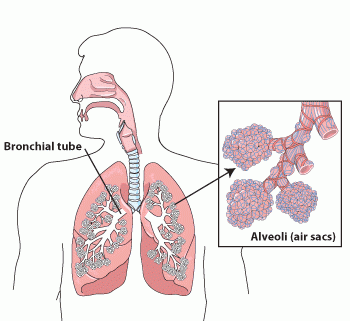 Chronic lower respiratory diseases comprise the 3rd leading cause of death in the US. The most deadly of these is chronic obstructive pulmonary disease (COPD), which makes it hard to breathe and includes two diseases: Emphysema and chronic bronchitis. Are you surprised to know that these lung diseases cause so much death?