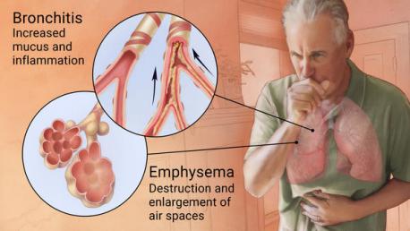 Damage to the lungs caused by COPD cannot be repaired. If the disease is found early, though, it might be possible to slow it down. If you have symptoms like shortness of breath, an ongoing cough, or chest tightness, your doctor can give you a simple test for COPD. Have you ever been tested for COPD?