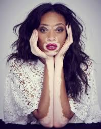 Chantelle Brown-Young, also known as Winnie Harlow, is not hard to spot. She's easily one of the most fascinating women to come out of