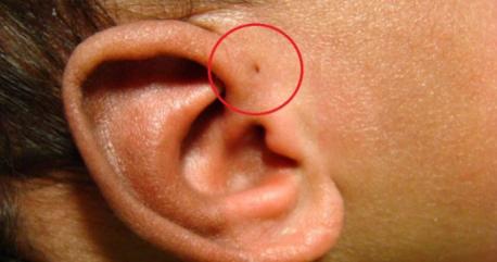 Back when living things had gills, the preauricular sinus, was common. But like that tendon from when people climbed trees, over time the trait has pretty much disappeared. But one in twenty people still have it. Are you or do you know someone who has this?