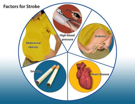 One of the big differences between stroke in older people and younger people is recovery. Stroke in young people can mean a lifetime of recovery and a loss of many productive years. The good news is that a 30-year-old has a better rate of recovery than an 80-year-old because of better brain plasticity, the brain's ability to adjust and learn new skills. Still, the best way to avoid a stroke, at any age, is to reduce the risk factors. Do you have any of the following risk factors for stroke?