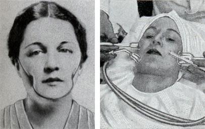 The focus on facial beauty has been around for a long time, and some went to great lengths, and excessive means to achieve it. Isabella Gilbert's metal brace could dig those desired dimples right into your face and a vacuum procedure that claimed to suck the wrinkles right out of your skin, called The Glamour Bonnet, which claimed to improve one's complexion by reducing air pressure around the skin, but looked more like the equivalent of putting a plastic bag over your head were only two such contraptions sold in the 30s and 40s. Have you ever gone to an extreme to achieve 