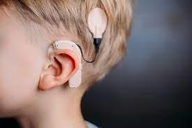 The Minnesota native has documented her journey from surgery to implant activation and beyond on TikTok, where she has more than 142,000 followers and her candid conversation about her condition has inspired others experiencing hearing loss. Cochlear implants, as Kent has, are reserved for patients who struggle to hear clearly, he added, since such hearing loss cannot be mitigated by hearing aids, which 