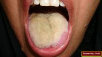 Your tongue is a window into what's happening in your body; color, coating and cracks are all indicators of the state of your health. What color is your tongue??
