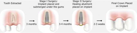 Why did you have to get a dental implant?