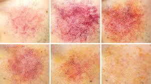 Bruise Color Chart