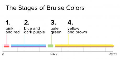 Yellow and brown. After the seventh day from the time of injury, your bruise begins lightening to a pale yellow or light brown shade. This is the last stage of your body's re-absorption process. Your bruise won't change color again. Instead, it will gradually fade away until it's completely gone. Sometimes people get bruised in the most unusual ways. Last year I saw a man who had almost half of his face badly bruised and the arm on the same side. It looked as if he had fallen in a very weird way. While talking to him, he let me know he was robbed and the thief hit him with all his strength against the wall in the street, just to get his cellphone and his wallet. Did you ever get bruised in a violent situation?