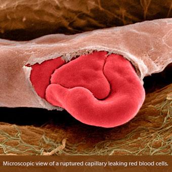 (Source: Healthline.com) In some cases, a bruise won't change color or seem to be healing in any way. A bruise that is firm to the touch, begins growing in size, or becomes more painful as time passes (not less) can be a sign that a hematoma has formed. A hematoma is a lump that forms when blood begins collecting under the skin or in a muscle. Instead of the process described above in the stages of bruising, the blood in a hematoma is