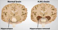 HM suffered from severe epilepsy and received brain surgery to relieve his symptoms. The surgery removed an area of his brain that we now call the hippocampus. The hippocampus helps store new memories. Therefore, poor HM was unable to store any new memories for much longer than 1-2 minutes for the rest of his life! Did you know this, and do you find it interesting?
