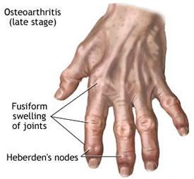 Swollen and painful fingers are the results of arthritis. The two most common types are osteoarthritis (OA) and rheumatoid arthritis (RA). RA usually affects both hands and often involves the joints where the fingers meet the hands. OA may affect a single hand or digit and often leads to bony overgrowths at the finger's middle or last joint. Stuart Kaplan M.D. is chief of rheumatology at Mount Sinai South Nassau in Oceanside, NY. He notes there are great drugs for RA called biologics that can change the course of the disease and stop it in its tracks if caught early enough. For OA, nonsteroidal anti-inflammatory drugs (NSAIDS) and anti-inflammatory creams help with the discomfort. Do you suffer from pain in your hands?