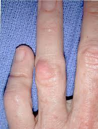 Yellow knuckle bumps are often deposits of fat called xanthomas. People who have them may have high levels of lipid in their blood. Xanthomas may signal diabetes, liver disease or an underactive thyroid. Please consult a doctor who will help tackle the problem of high lipid levels with a cholesterol-lowering drug. Were you aware of yellow knuckle bumps before this survey?