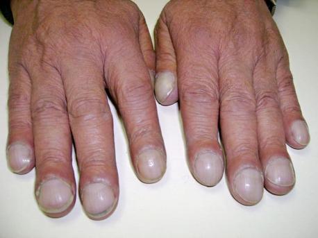 Nails that curve down and bulging fingertips are signs of possibly serious lung conditions. The most common are lung cancer, COPD and tuberculosis. People with symptoms are urged to see a doctor as soon as they notice a change since treatment may require speed. Have you ever been a caregiver for someone with COPD?
