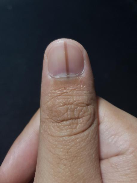 Black or brown streaks in a fingernail might be a mole or signs of infection. However, it can also indicate melanoma, the most deadly form of skin cancer. Nail melanoma is rare but much more deadly than skin melanoma. The nail may split, bleed or seep pus. It's important to diagnose early. See a doctor if you notice dark streaks in your nails. Change may go unnoticed by those who get regular manicures so give nails a good examination monthly. Were you aware of nail melanoma before taking this survey?