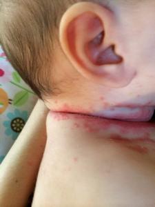 Have you ever heard of having a yeast infection type fungus on the back of the neck in kids?