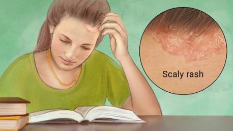 Psoriasis is a skin disease that causes scaling and inflammation (pain, swelling, heat, and redness). Skin cells grow deep in the skin and slowly rise to the surface. This process is called cell turnover, and it takes about a month. With psoriasis, it can happen in just a few days because the cells rise too fast and pile up on the surface. Most psoriasis causes patches of thick, red skin with silvery scales. These patches can itch or feel sore. Do you or a family member suffer from the skin disease psoriasis?