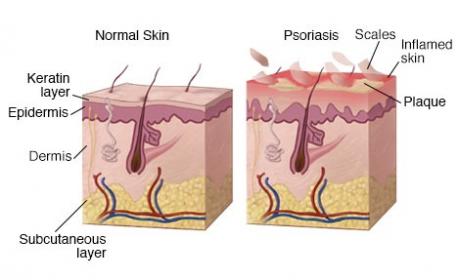 Psoriasis begins in the immune system, mainly with a type of white blood cell called a T cell. Psoriasis can be caused by infections, stress, changes in the weather that dry the skin, and certain medicines. Were you aware of these facts?