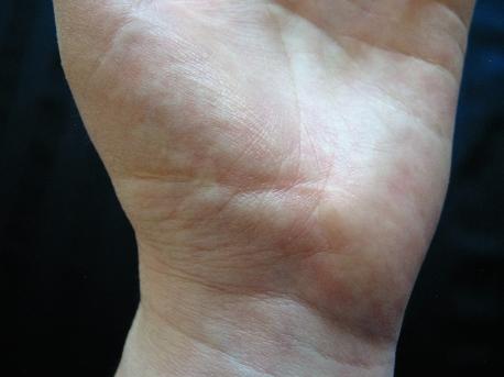 I have got two old scars on my left hand. Do you have any scars on your hand?