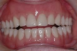 Would you date someone with bad teeth