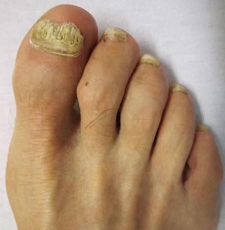 Do you suffer from toenail fungus?