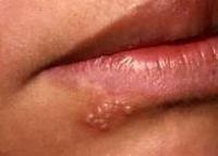 Did you know that cold sores are a form of Herpes called HSV-1?