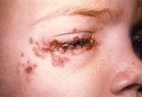 Did you know there are cold sores that appear in other places than the lips or mouth area?