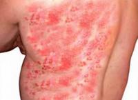 Have you or anyone you know ever got the shingles virus??