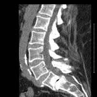 On Monday the 9th I am having back surgery. I have what they call Spondylolisthesis. As you can see in my ex ray, at the bottom where it is bone on bone, the disk in between it was worn away. Have you ever heard of Spondylolisthesis??
