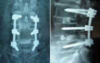 What they are going to do is called fuse a section of my spine by putting in screws and rods on each side of my spine, lifting up where the disk was and then tighten them where they won't move again. Do you think I will set off alarms going threw a metal detector??