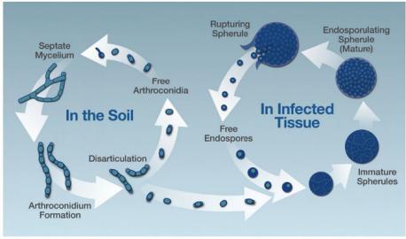 Coccidioidomycosis or 