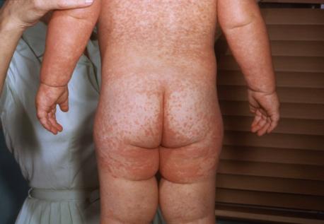 Antivaxx sentiment come to a head (again) during the Covid-19 pandemic, with protests and rhetoric similar to the smallpox vaccine in the 19th century. 16% of Americans said they would