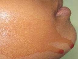 An alternate theory is that some people might have atypical little pockets within the structure of their skin that could collect blood and allow it to leak into hair follicles or onto the skin's surface. Have you ever experienced hematidrosis yourself?