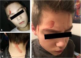 Possible treatments prescribed by doctors include beta-blockers or vitamin C to lower blood pressure, medications to lessen emotional stress, and drugs to promote blood clotting. How would you feel if you started to sweat blood?