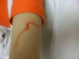 One theory is that hematidrosis occurs when capillaries rupture during high levels of psychological stress, causing blood to seep into the sweat glands and then out onto the skin. Have you ever known anyone who experienced sweating blood?