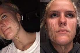 Do not cry right after a spray tan, or you could get the pictured result! If you had any of the treatments mentioned in this survey, did you ever have a bad outcome?