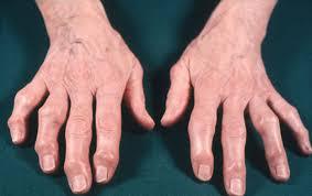 Osteoarthritis is most common in knees, then hips, then hands. Where is your osteoarthritis located?