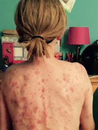 It shows up as spots on the arms, face and body, have you ever seen someone with a severe case of this?