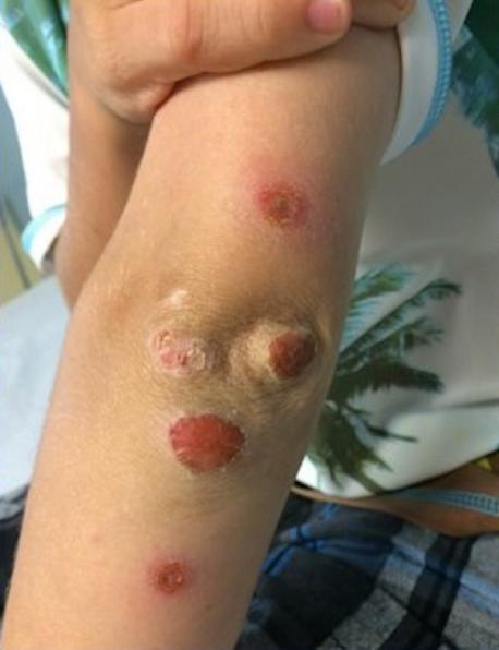 Brenda Sanderson's son came back from a friend's birthday party where they had such a castle and after a few days had sores on his arms, has this ever happened to your child?