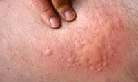 Do you suffer from chronic hives?