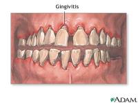 Have you been diagnosed with gingivitis or gum disease?