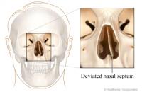 The nasal septum is the bone and cartilage that divides the nose into two somewhat equal passages (your nostrils). Sometimes the septum is crooked or off-centre resulting in the nasal passages being partially obstructed and often more narrow than usual. Do you have, or have you ever had, a deviated septum?