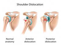 Have you ever dislocated one of your joints?